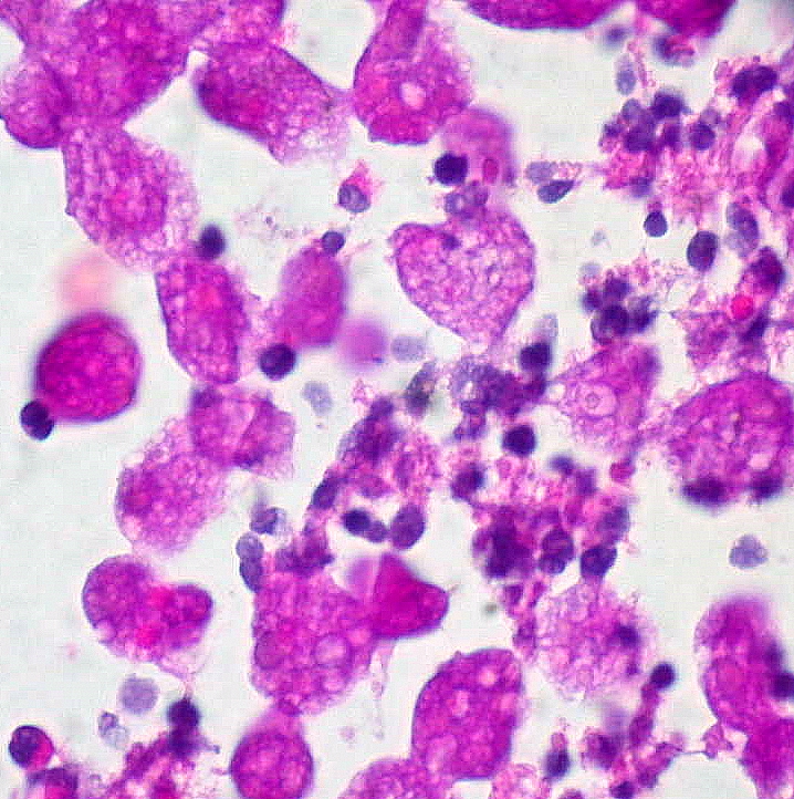 Amöbenkolitis
